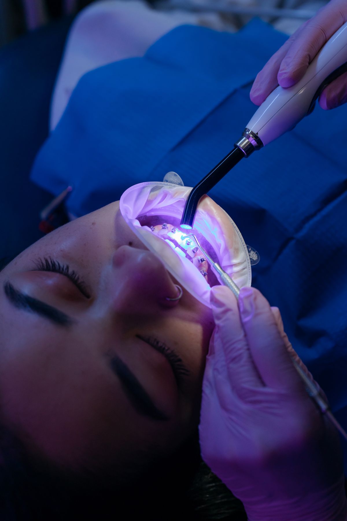 Teeth whitening session